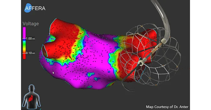 Affera, Inc. Announces Successful First-In-Human Use Of SpherePVI Circumferential Pulmonary Vein Isolation Device Using Pulsed Field Energy
