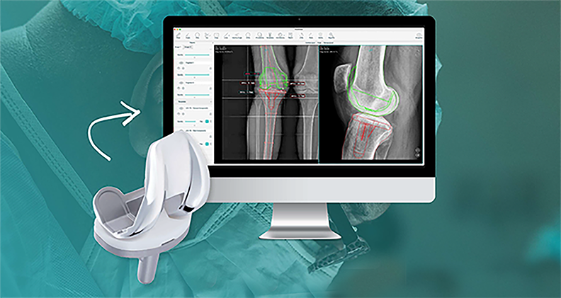 Examining a Partnership Up Close: GO Implants and PeekMed