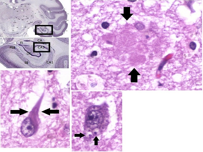 AC Immune reports positive data from Alzheimer’s disease vaccine trial