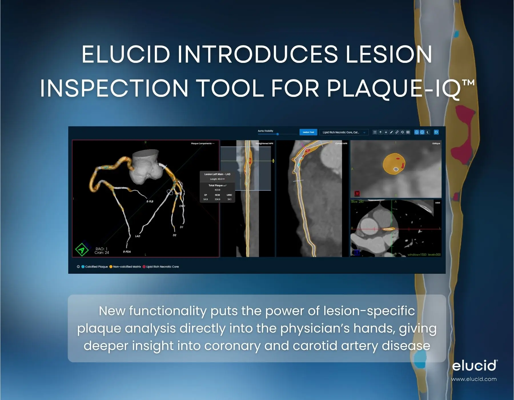 Elucid Announces Commercial Availability of Lesion Inspection Tool for Plaque-IQ
