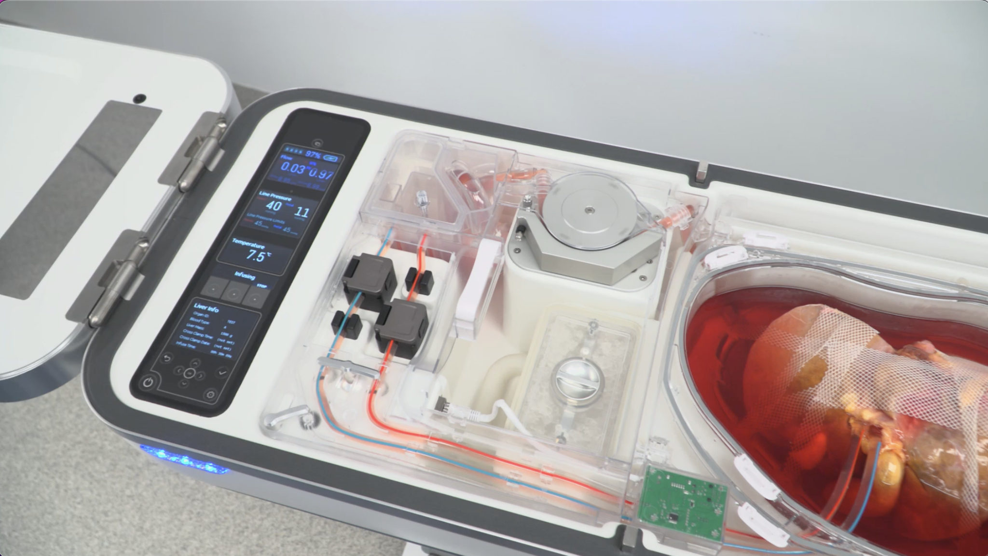 LifePort Liver Transporter Preserves First Livers for Transplant as Part of the PILOT Continued Access Study