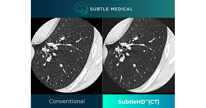 Subtle Medical Receives FDA Clearance for SubtleHD(CT), Expanding AI-Powered Image Enhancement into CT Imaging