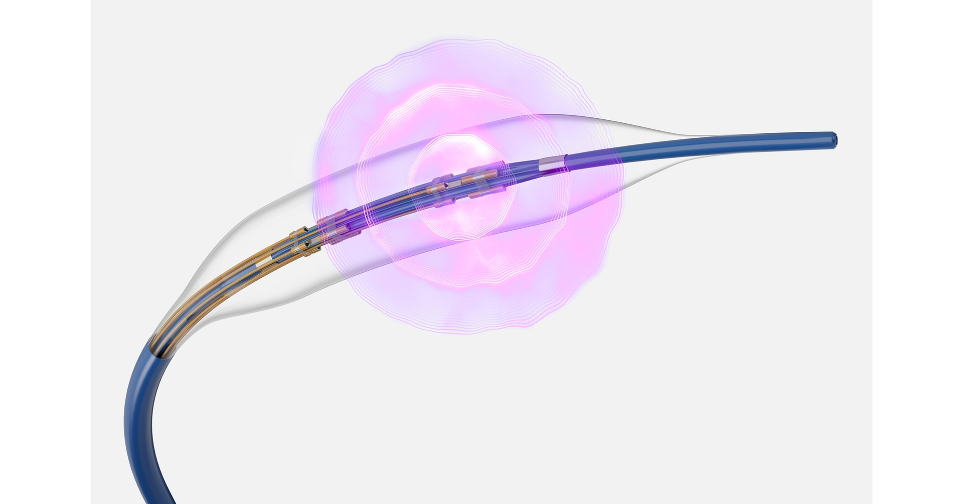 FRACTURE IDE trial of Boston Scientific SeisMIQ coronary intravascular lithotripsy catheter meets primary endpoints