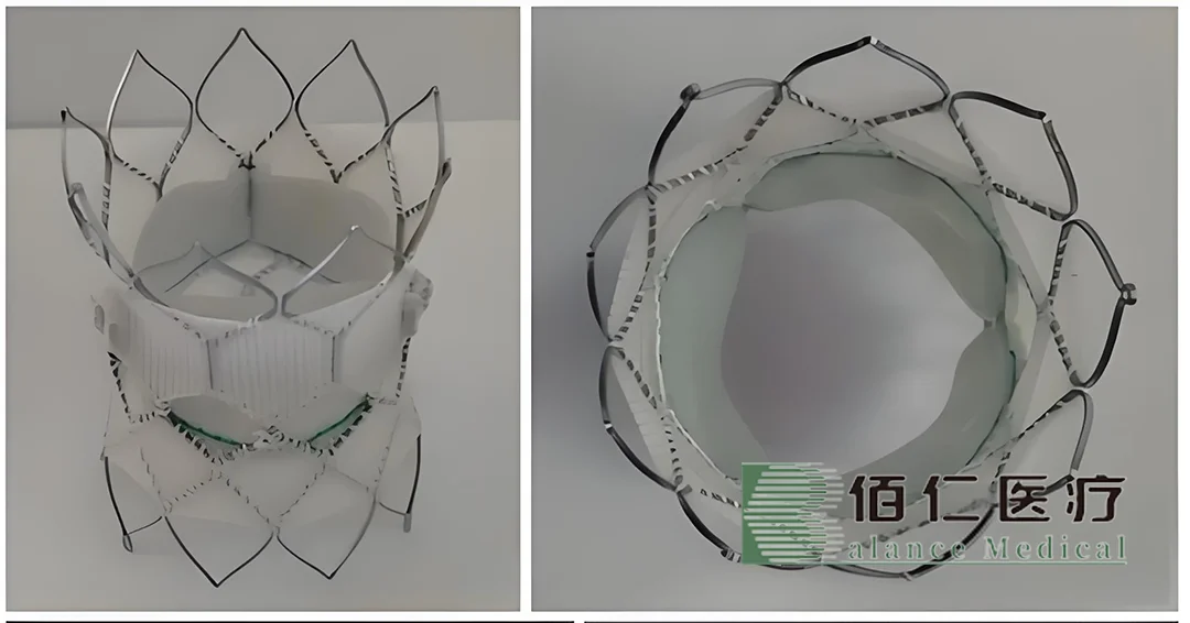Balance Medtech's Interventional Pulmonary Valve Receives Fast-Track Designation from NMPA