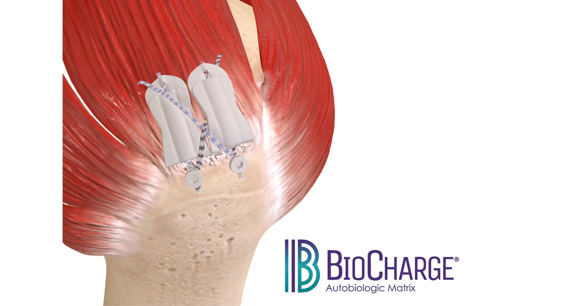 Atreon Orthopedics Announces FDA 510(k) Clearance and Full Market Launch of BioCharge® Autobiologic Matrix for Rotator Cuff Repair