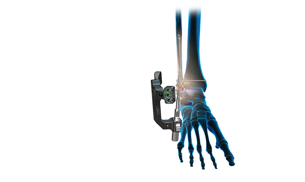 Arthrex Introduces FibuLock PRO Fibular Nail, Improving Ankle Fracture Outcomes