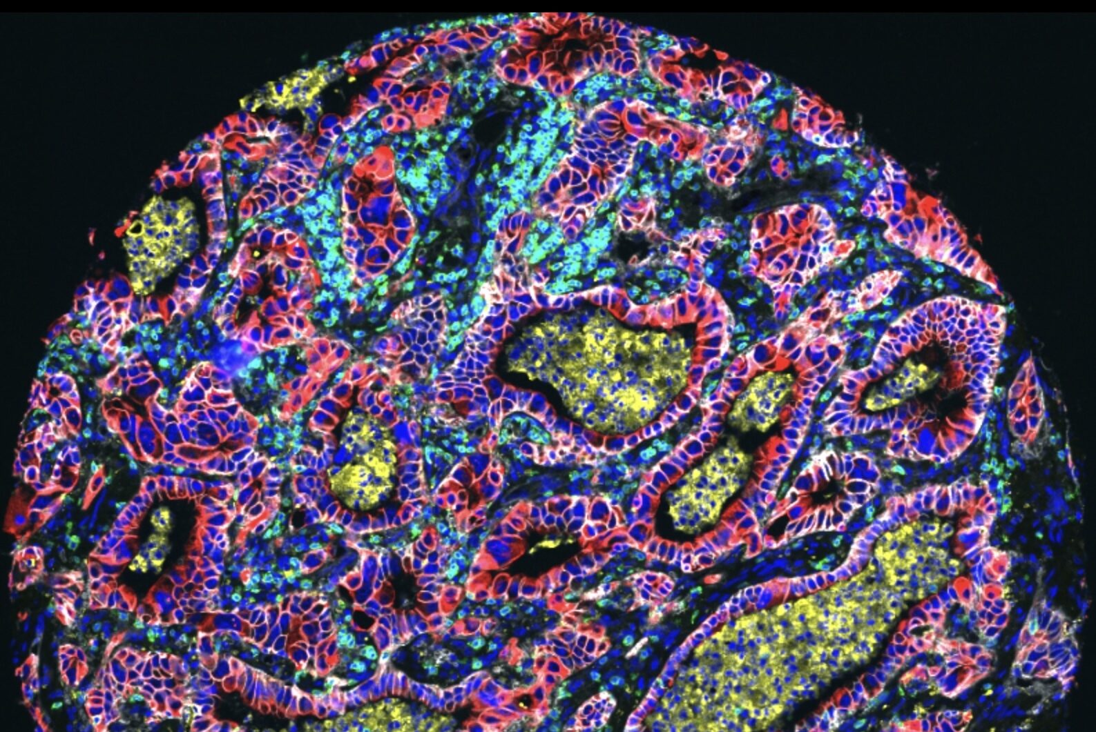 Spatial Biology and AI Combined by Noetik to Develop Immuno-Oncology Drugs