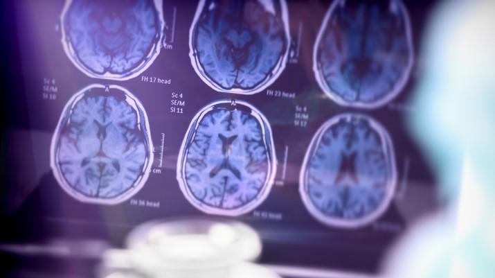Roche’s Genentech returns Alzheimer’s assets to AC Immune, cutting 18-year tie to the biotech