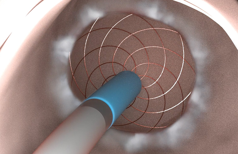 Aqua Medical wins FDA IDE to launch trial for ablation procedure that treats diabetes